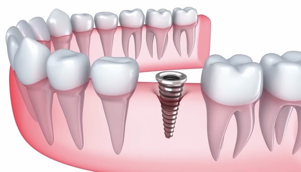 Dantų implantavimas