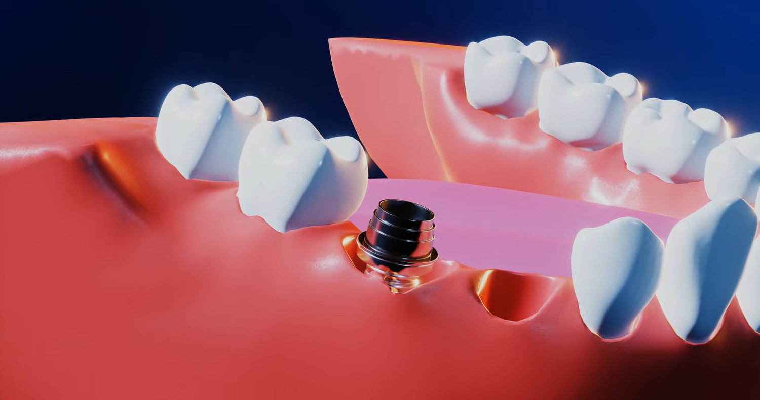 dantų implantai